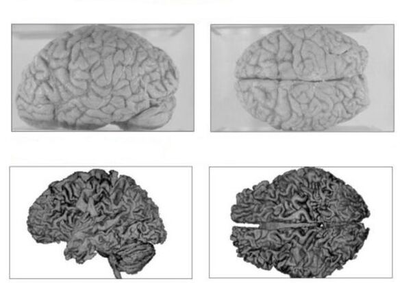 Mozek zdravého člověka (nahoře) a mozek alkoholika s nevratnými následky (dole)